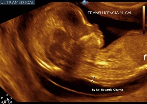 Translucência Nucal