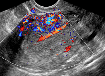 Ultrassonografia na ProfileraÃ§Ã£o Anormal do EndomÃ©trio