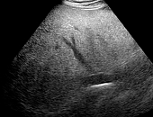 Ultrassonografia da Esteatose HepÃ¡tica