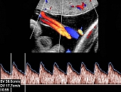 Ultrassonografia do CordÃ£o Umbilical