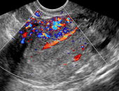 Ultrassonografia na ProliferaÃ§Ã£o Anormal do EndomÃ©trio