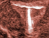 Ultrassonografia e o Dispositivo Intrauterino