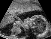 Ultrassonografia na Hidropisia Fetal