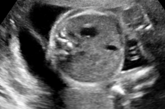 Ultrassonografia do Ãmnio e da Cavidade AmniÃ³tica