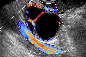 Ultrassonografia do FolÃ­culo Ovariano