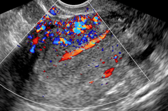 Ultrassonografia na ProliferaÃ§Ã£o Anormal do EndomÃ©trio