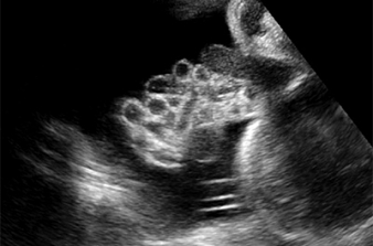 Ultrassonografia das Anomalias da Cavidade CelÃ´mica