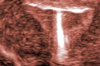 Ultrassonografia e o Dispositivo Intrauterino