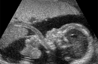 Ultrassonografia na Hidropisia Fetal