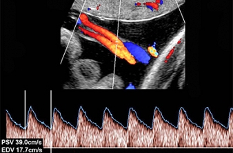 Ultrassonografia no Sofrimento Fetal CrÃ´nico
