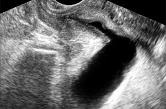 Ultrassonografia da Uretra Feminina