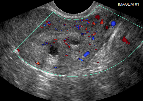 Adenomiose